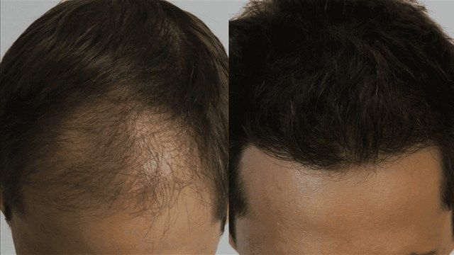 Hair Transplant