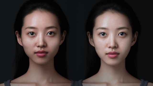 Zygoma Reduction (Malarplasty) 